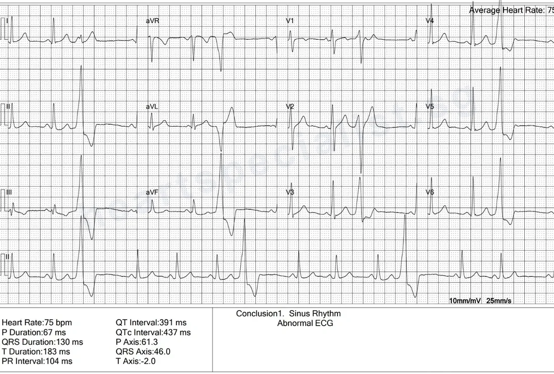 A 12-lead ECG report printed with the conclusion &ldquo;Sinus Rhythm, Abnormal ECG&rdquo;, showing frequent wide early beats (premature ventricular complexes, or PVCs) along the rhythm strip