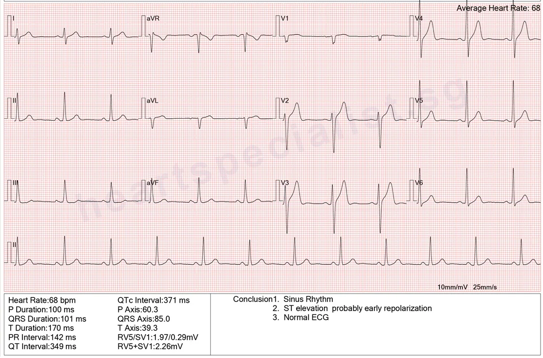 A 12-lead ECG report from a 38-year-old man, reported as &ldquo;Sinus Rhythm, ST elevation probably early repolarization, Normal ECG&rdquo; &mdash; a normal tracing that was still flagged for ST elevation